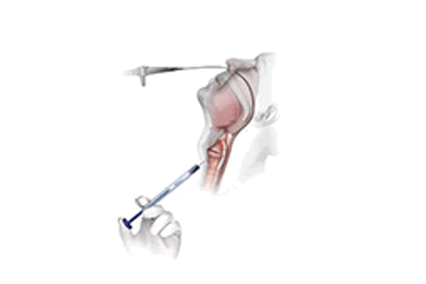 Soluvos Medical Renú® Voice Injectable Implant