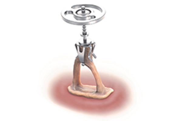 ALTO NyteByte™ Partial