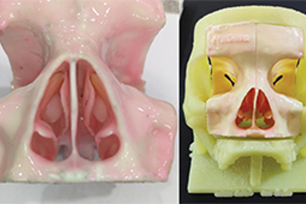 3D Paranasal Sinus Model